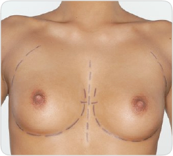breast01